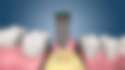 日常生活中预防牙结石的方法