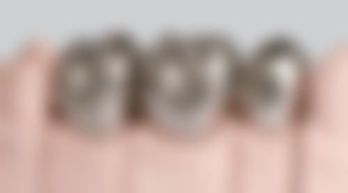 全瓷烤瓷牙：美观与健康的优选