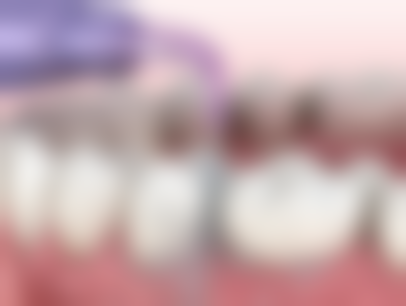 地包天矫正器带多久？受多种因素影响，时长一般6 - 24个月，复杂情况可达1 - 3年！ 