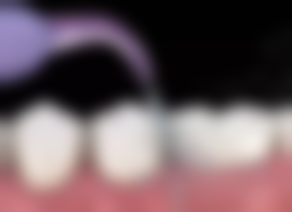 缩短牙齿根管治疗时间的方法