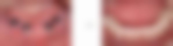 刘大爷种植牙案例