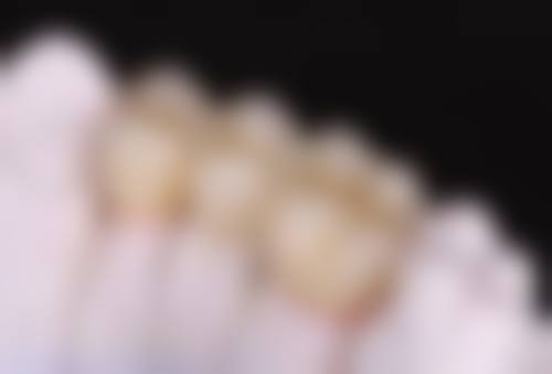 国产种植牙材料：崛起与不断追赶