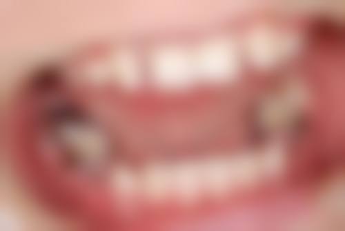 拔牙后疼痛异常的情况及处理