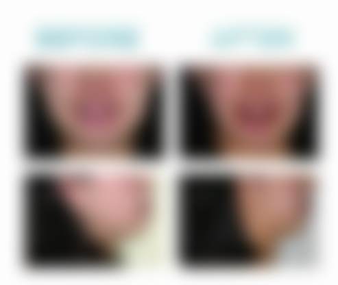 北京禾禾口腔数字化无托槽隐形矫治的成效展示