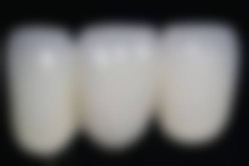 洗牙的注意事项
