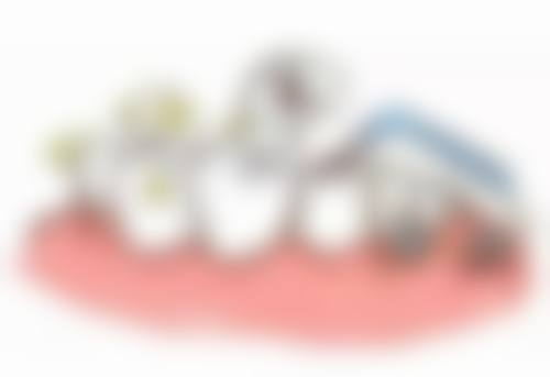 牙齿变色适合做烤瓷牙