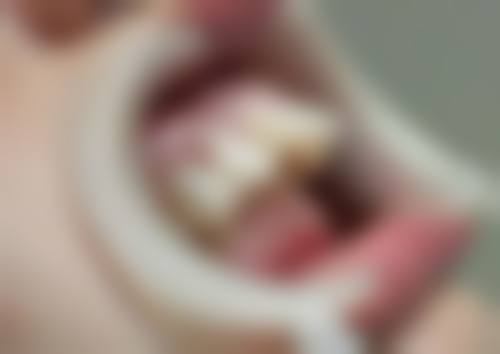 居家处理拔牙后十小时渗血的办法