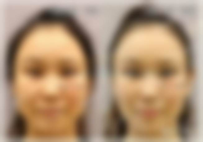 北京克莱美舍医疗美容张冰洁院长开外眼角案例