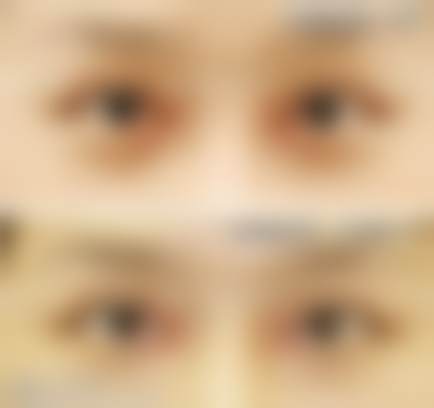 张氏内眼角修复案例