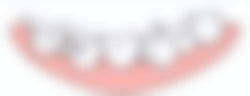 提高全口种植牙成功几率的方法