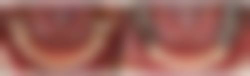 佛山禅城郑东锋口腔诊所治疗反馈与口碑评价。