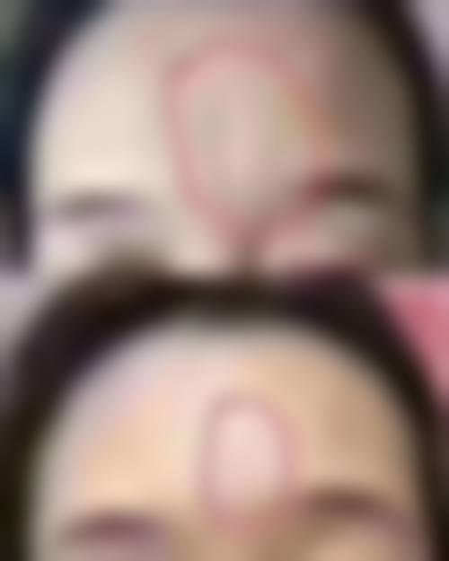 普洱悦里整形医院治疗反馈与口碑评价。